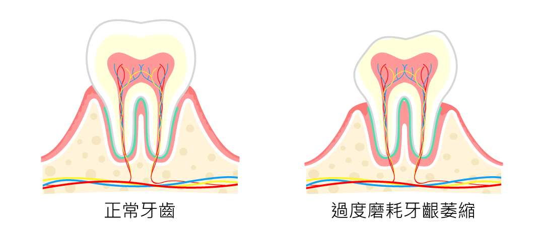 YOZAI-牙齒過度磨耗與牙齦萎縮