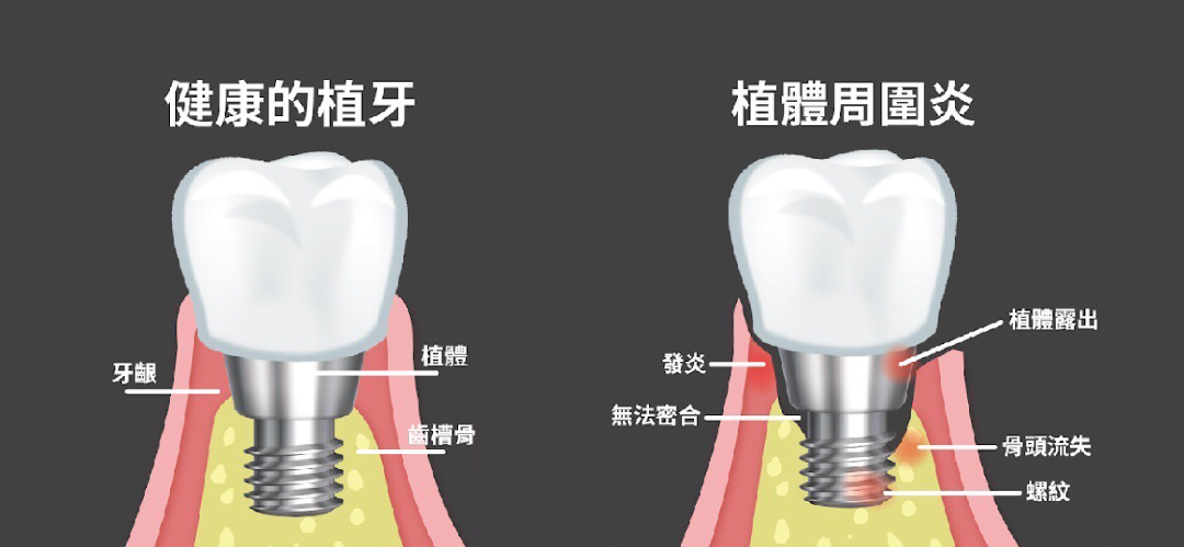 YOZAI-植牙-植體周圍炎