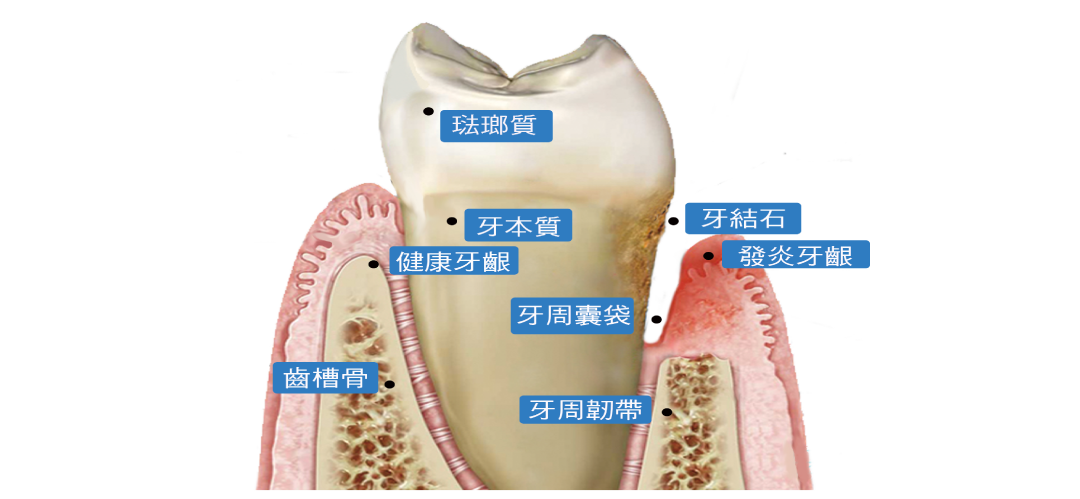 YOZAI-牙周炎症狀說明