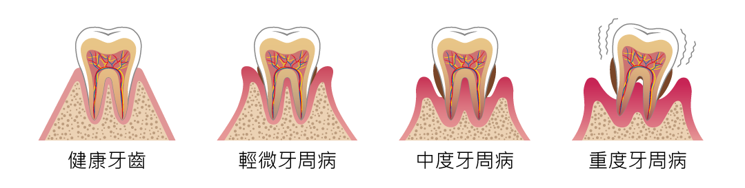 YOZAI 牙周病輕重狀況